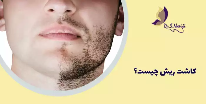 کاشت ریش چیست؟