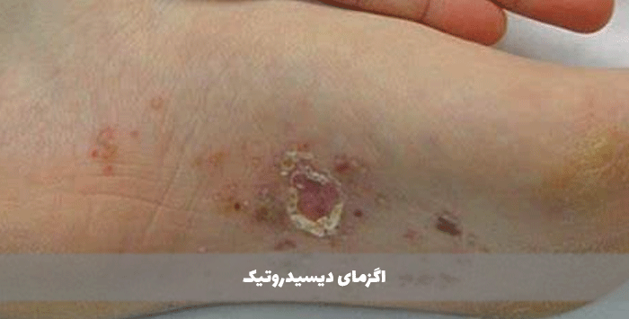 اگزمای دیسیدروتیک