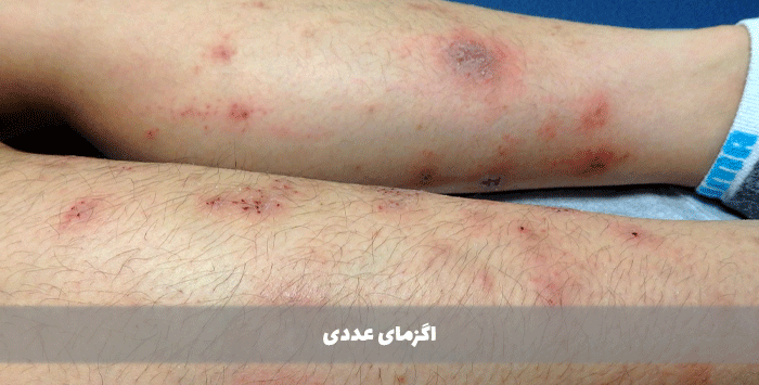 اگزمای عددی