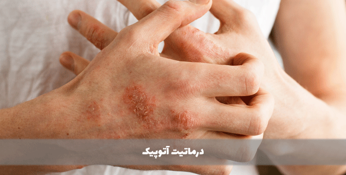 درماتیت آتوپیک