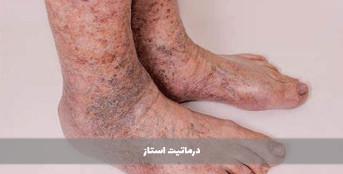 درماتیت استاز