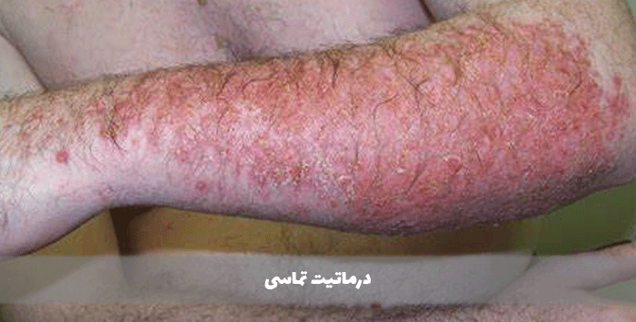 درماتیت تماسی