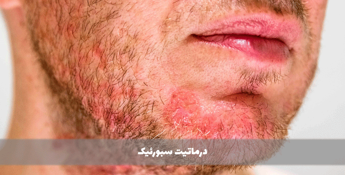 درماتیت سبورئیک
