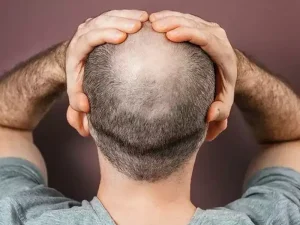 روش های درمان ریزش مو