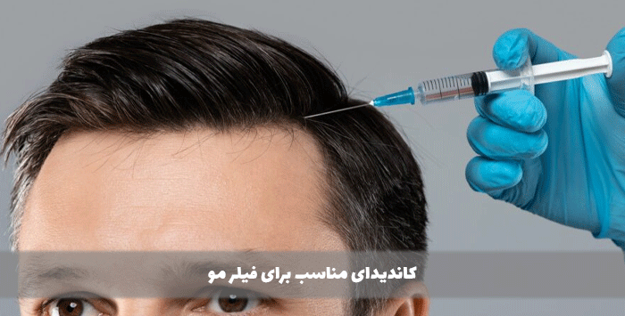 کاندیدای مناسب برای فیلر مو