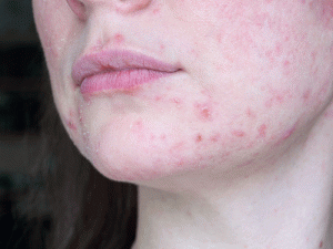 درمان اکنه روزاسه