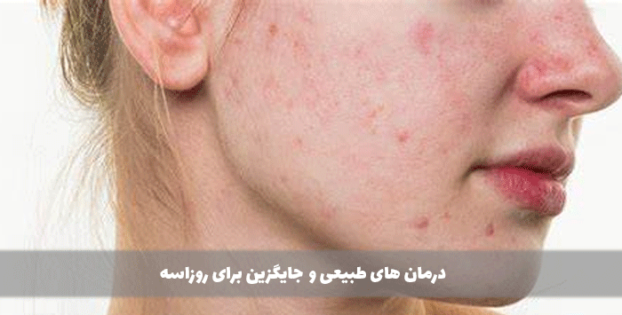 درمان های طبیعی و جایگزین برای روزاسه