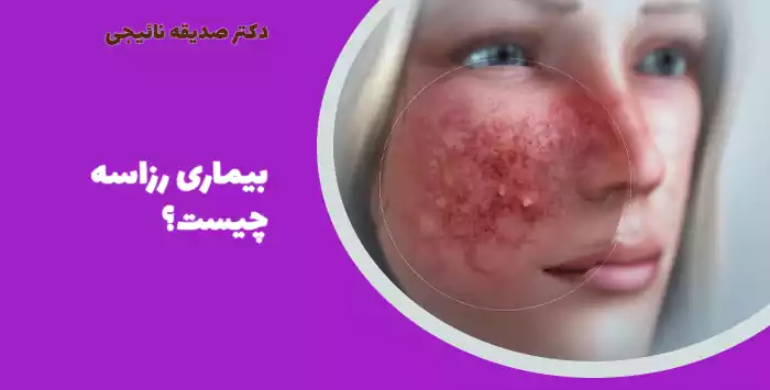 بیماری رزاسه چیست؟