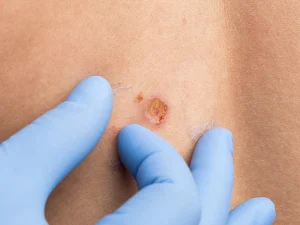 مراقبت‌ های بعد از برداشتن خال