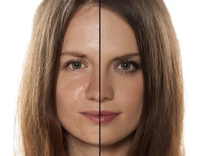 براق شدن پیشانی بعد از تزریق بوتاکس