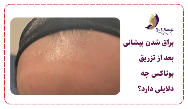 براق شدن پیشانی بعد از تزریق بوتاکس چه دلایلی دارد؟