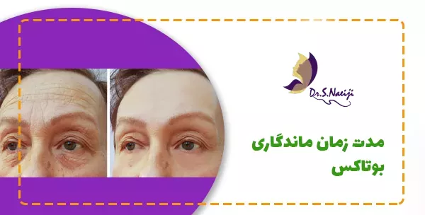 مدت زمان ماندگاری بوتاکس