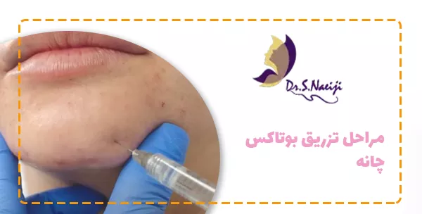 مراحل تزریق بوتاکس چانه