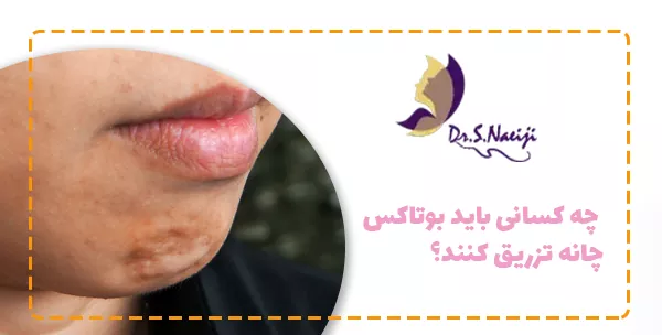 چه کسانی باید بوتاکس چانه تزریق کنند؟