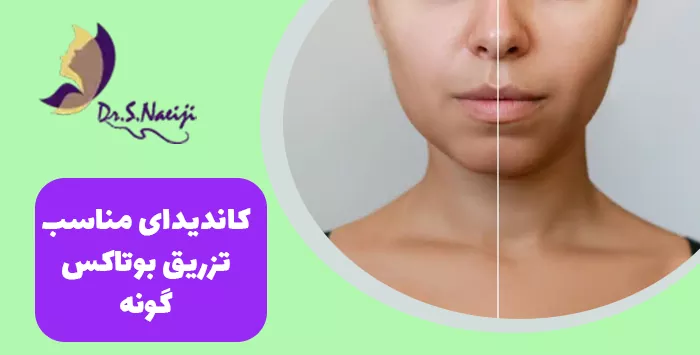 کاندیدای مناسب تزریق بوتاکس گونه