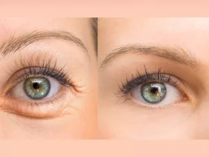 بوتاکس دور چشم