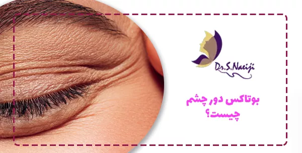 بوتاکس دور چشم چیست؟