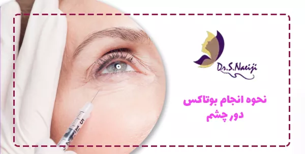 نحوه انجام بوتاکس دور چشم