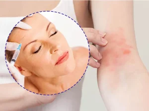 اثر اگزما بر بوتاکس