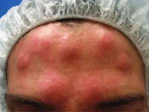 حساسیت به بوتاکس